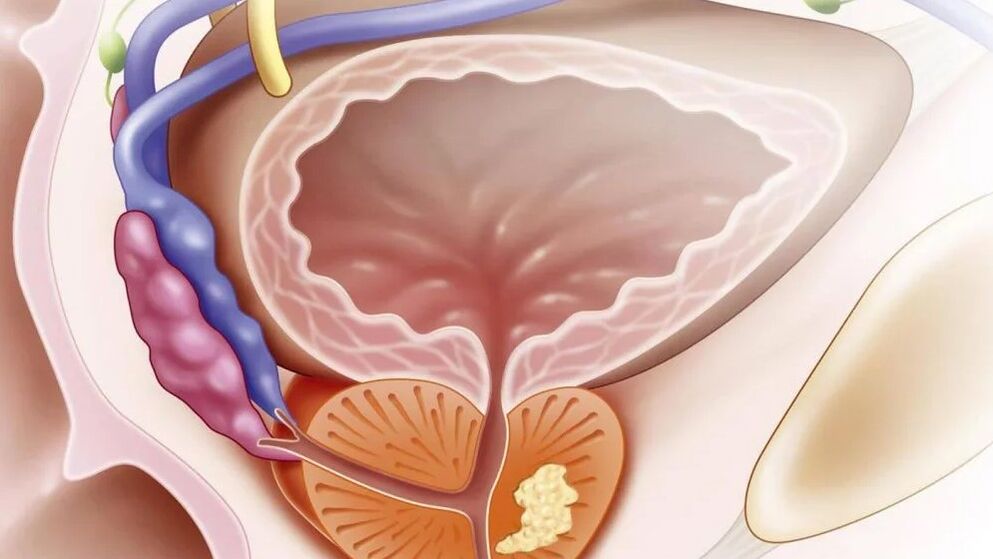 Nada prostatitis crónica