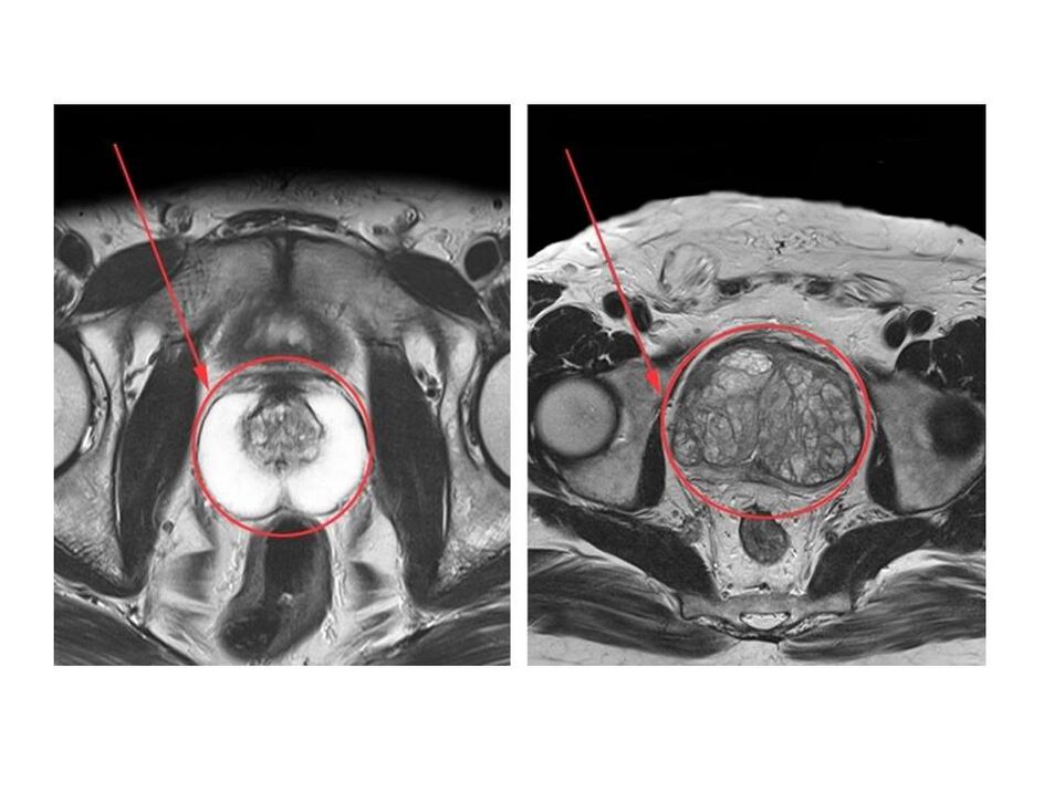 Comparación de una próstata sana (izquierda) y una inflamada (derecha) en imágenes de resonancia magnética