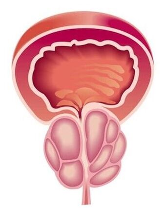 Síntomas de prostatitis en hombres.