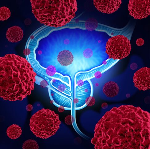 La actividad de los microorganismos patógenos es la causa del desarrollo de la prostatitis.