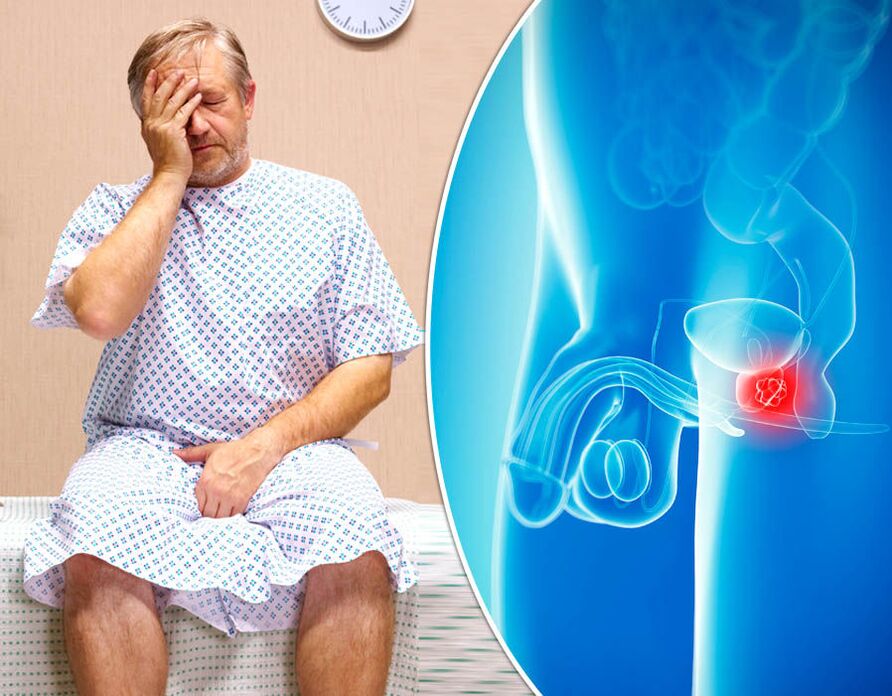 Un hombre con prostatitis es diagnosticado con la enfermedad.