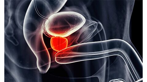 Inflamación de la glándula próstata