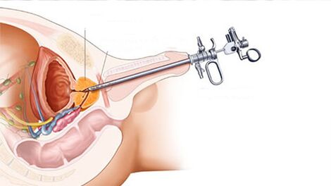 Tratamiento quirúrgico de la prostatitis